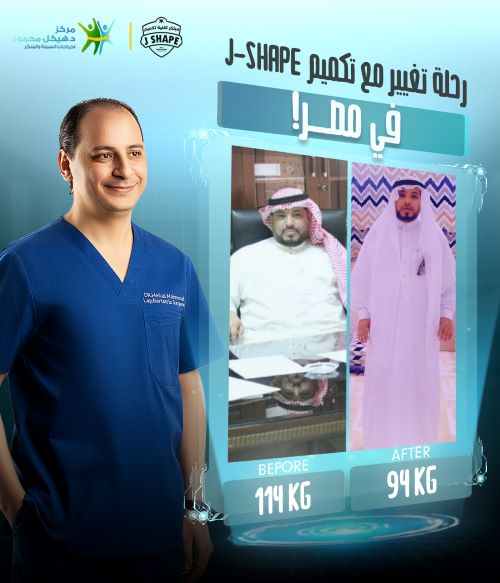تجاربكم مع عملية تكميم المعدة